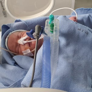 Anakku lahir prematur di 33 weeks