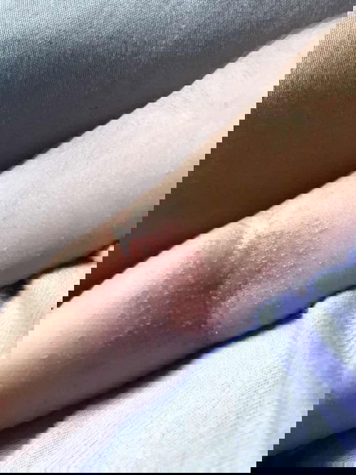 Bintik merah pada bayi