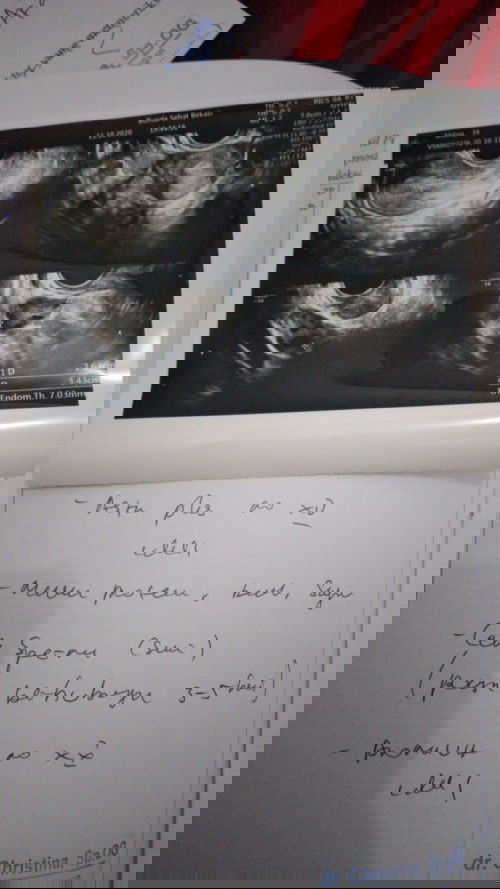 Ketidakseimbangan hormon dan hampir penebalan dinding rahim