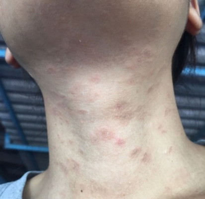 มีแม่ๆบ้านไหน ผื่นขึ้น แล้วเป็นรอยดำแบบนี้บ้างคะ