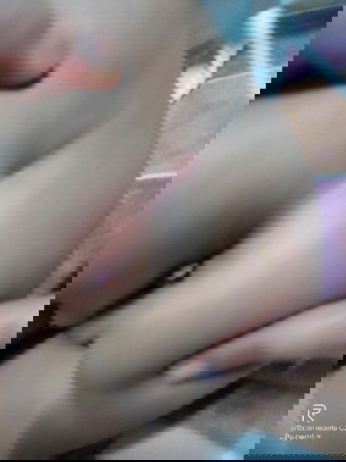 Skintag or almuranas?