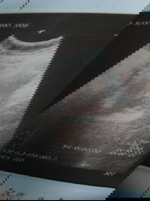 ragu akan kbnaran tidak hamil