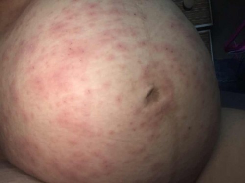 36 weeks ผื่นขึ้นเต็มท้อง เต็มตัว
