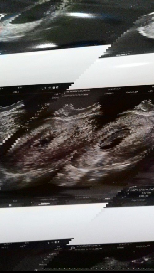 Janin tidak berkembang dn tdk ada djj Nya