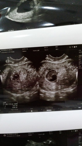 Janin tidak berkembang dn tdk ada djj Nya