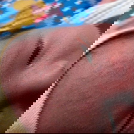 rashes??