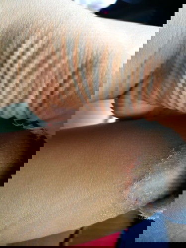 แม่บ้านไหนที่ลูกมีแผลกดทับหรือแผลตรงข้อพับบ้าง ลูกเรามาที่ข้อเท้่า น้องพฤติกรรมชอบยืน