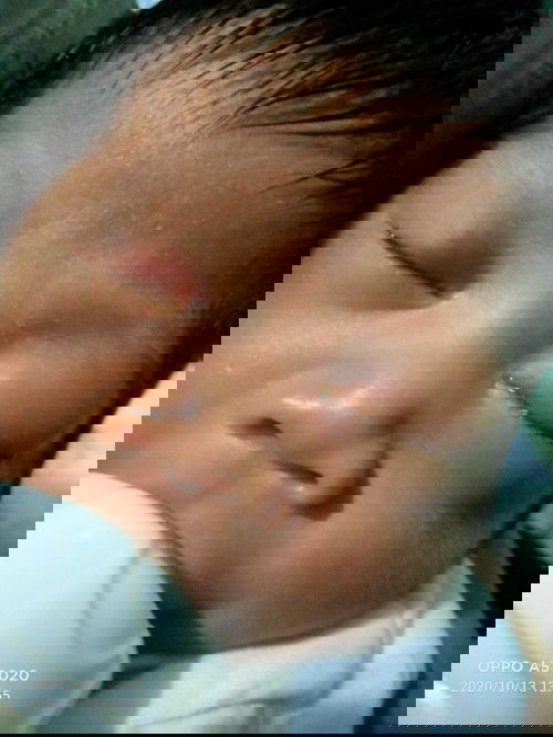 Nagmumuta ANG Mata Ng baby