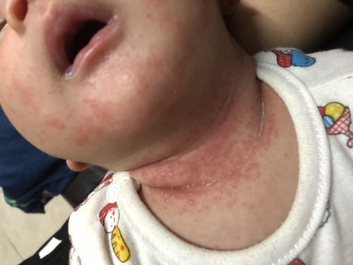 คอลูกเป็นผื่น ทำไงดีคะ