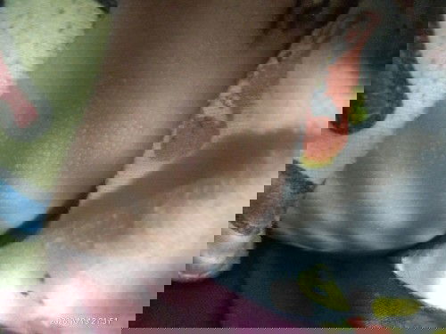 Kecemasan akibat bintik2 pada kulit si bby