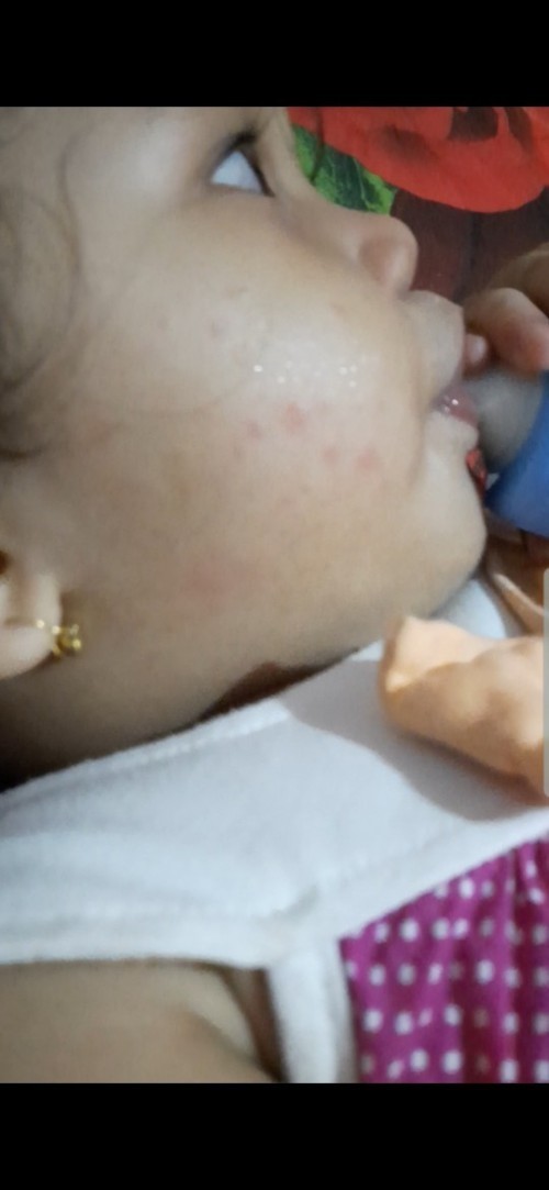 Ruam kulit baby 1 th hilang timbul