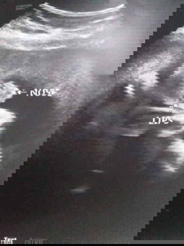 Ultrasound pic