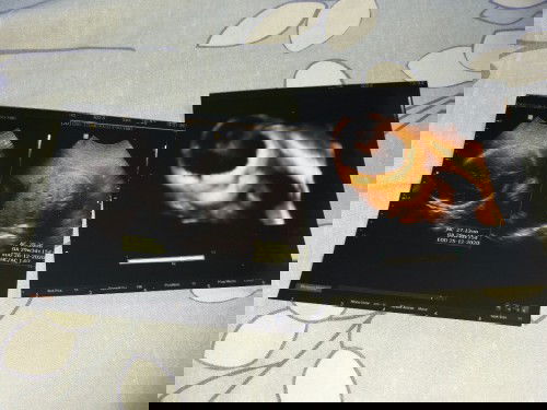 Leher terlilit tali pusar