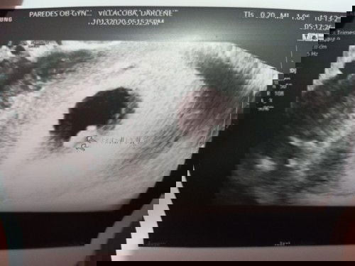 First Time mum ,7weeks and 5days pregnant, without Heartbeat