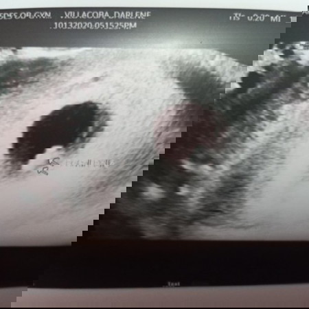 First time mum, 7weeks and 5 days pregnant, without heartbeat