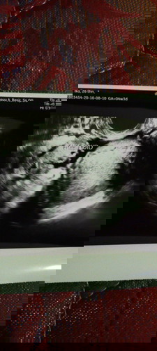 Hamil 4w. Sudah USG trans-V tapi kata dokter tidak kelihatan, kantong pun tidak kelihatan