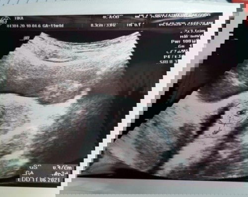 Tespek negatif, USG hamil