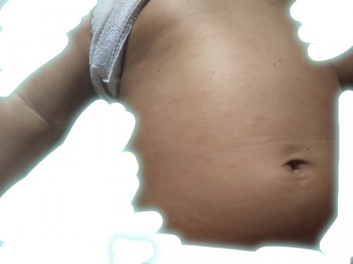 Gara2 panas atau ruam popok ?