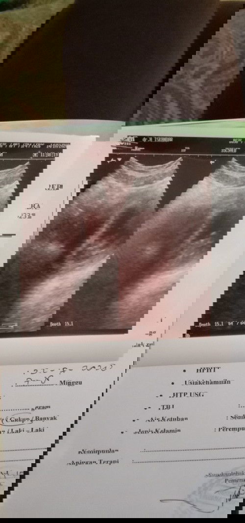 Usia USG dan usia HPHT berbeda