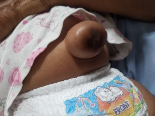 สะดือจุ่น(ไส้เลื่อน)