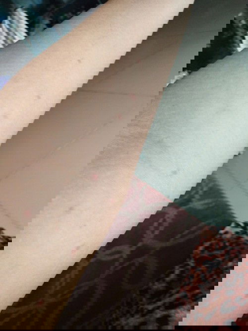 มีใครเคยเป็นผื่นแบบนี้ไหมค่ะ
อยู่เฉยๆก็ขึ้นอย่กทราบว่าเป็นไรไหมค่ะพอดีตอนนี้35.5วิคแล้วกังวนมากๆกลัว