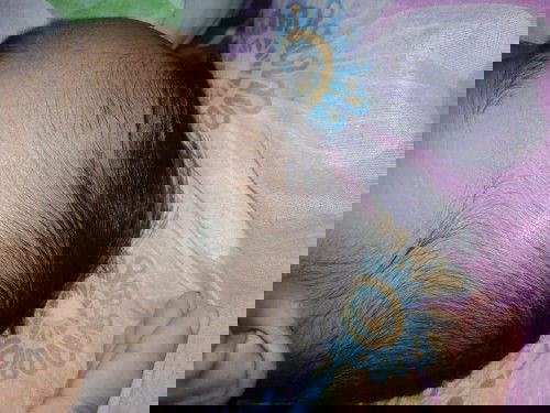 Kepala anak benjol ada cairan