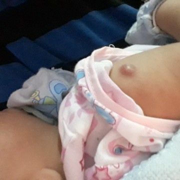 ฝีดาษเป็นหนองต้องทำไง