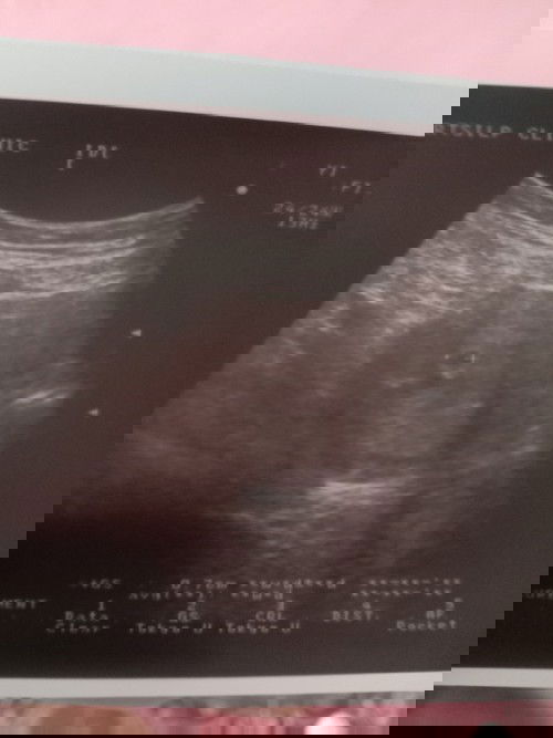 แม่ๆคนไหนเห็นตัวอ่อนตัวกี่วีคค่ะ แล้วมีเลือดสีน้ำตาลออกไหมค่ะ