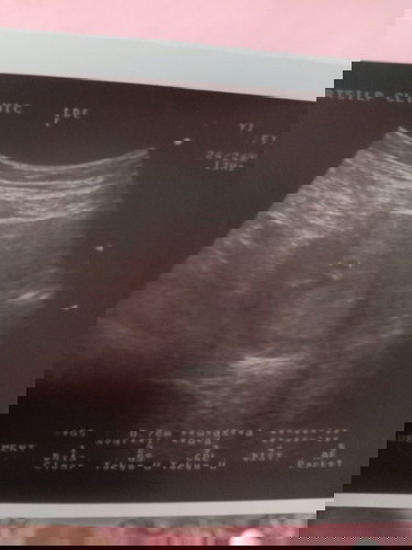 แม่ๆคนไหนเห็นตัวอ่อนตัวกี่วีคค่ะ แล้วมีเลือดสีน้ำตาลออกไหมค่ะ