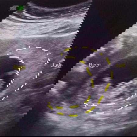 Congenital Anomaly Scan