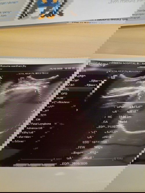 Induksi dan Pengapuran Plasenta