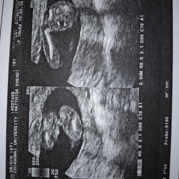 อยากทราบว่าน้องประมาณกี่เดือน