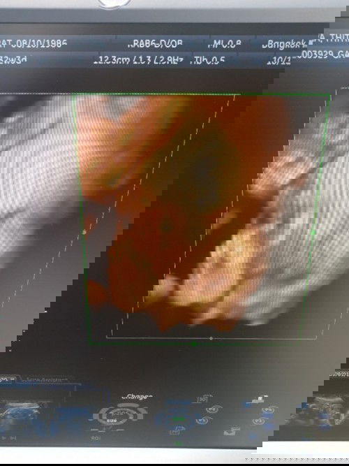 อัลตร้าซาวน์ 4มิติ