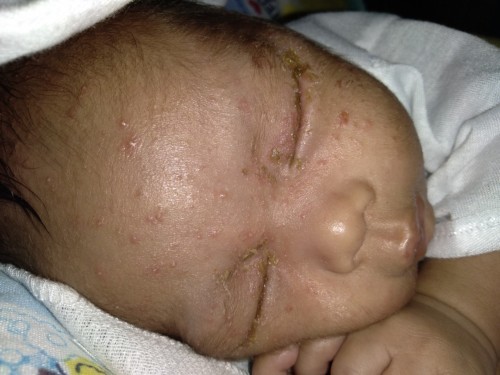 Newborn Rashes