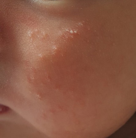 What is the spots on LO cheeks