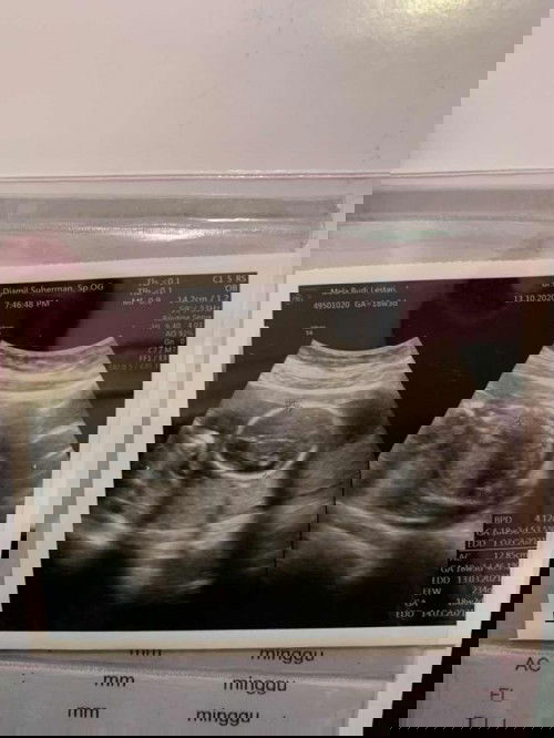 Tendangan bayi dalam perut