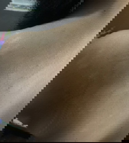 Skin rashes? Allergy po kaya ito?