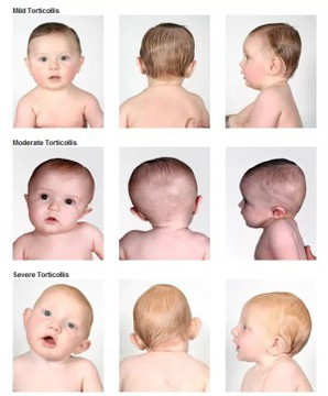 Torticollis