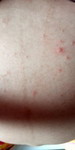 Rashes?????