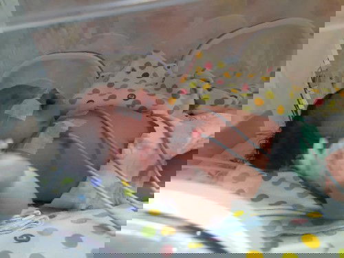 Cerita Kelahiran Bayiku dengan Tali Pusat Pendek