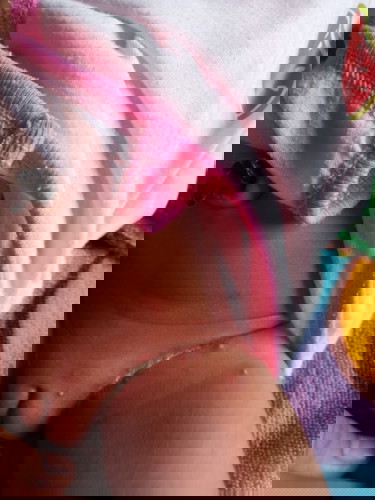 ลูกน้อยอายุ5วัน ผดผื่น