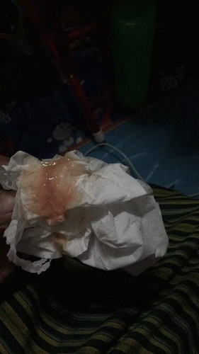 ลงมูกเลือดแต่หมอไม่ให้คลอด
35W + พอดีไปโรงบาลเตรียมของเตรียมอะไรไปเรียบร้อยทุกอย่างไปถึงในห้องคลอด