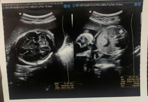 Cara Membaca Hasil USG