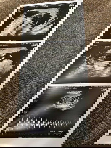 Sonogram at 15wks 1day