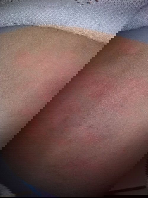 biang kringet atau alergi kulit