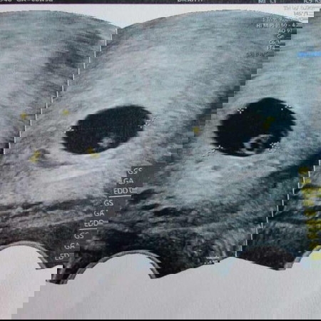 คุณแม่นับอายุครรภ์จากใบซาวกันใช่มั้ยค่ะ🥰