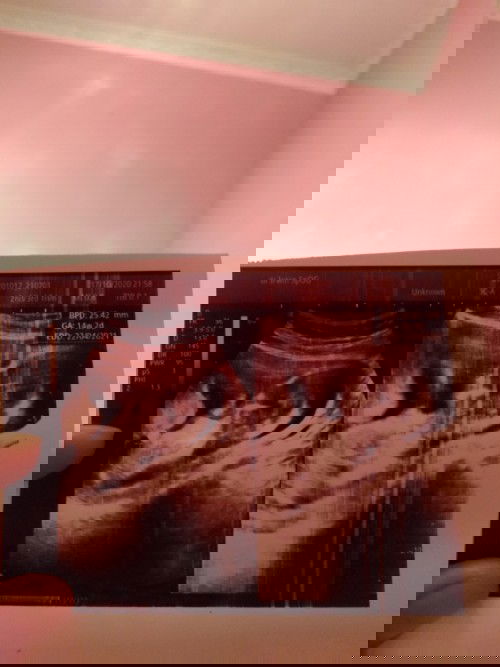 Hasil usg usia kandungan