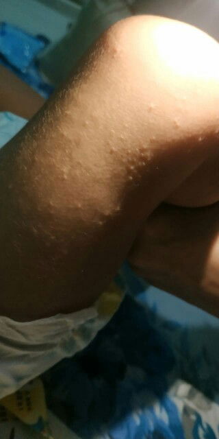 Bruntusan di paha bayi