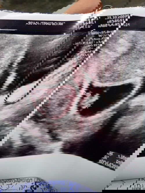 Bunda adakah yg tau...dari hptp usia kandungan saya 10w tp diusg 7w..dan janinnya dipinggir gitu