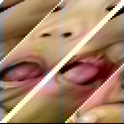 Sedih anak ada tangue tie dan lip tie